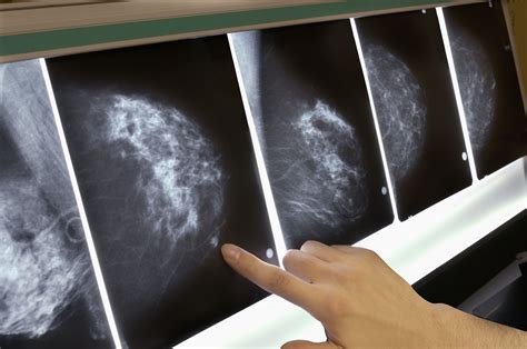 mamografia normal e com cancer